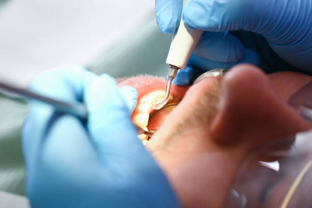 Best Emergency Dentist for Lost Fillings or Crowns in Montauk, NY